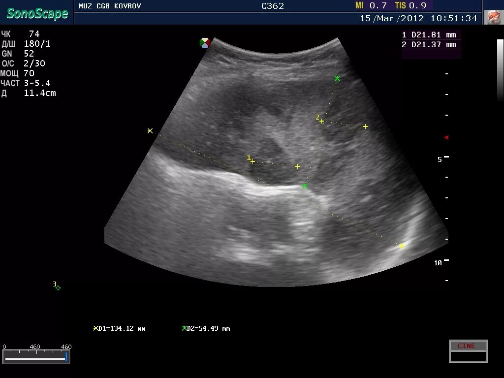 Где найти узи. Определить пол на узи. Где найти узи. Допплерометрия пупочной артерии. Портал ная гипертензия узи.