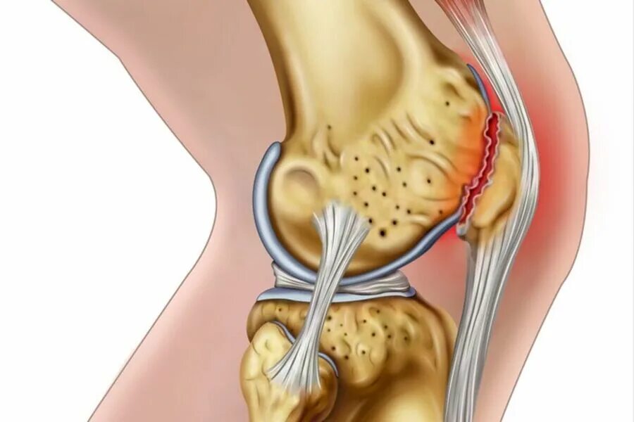 Разрыв сочленений. Разрыв мениска коленного. Внутренний менисцит коленного сустава. Мениск коленной чашечки что это такое.