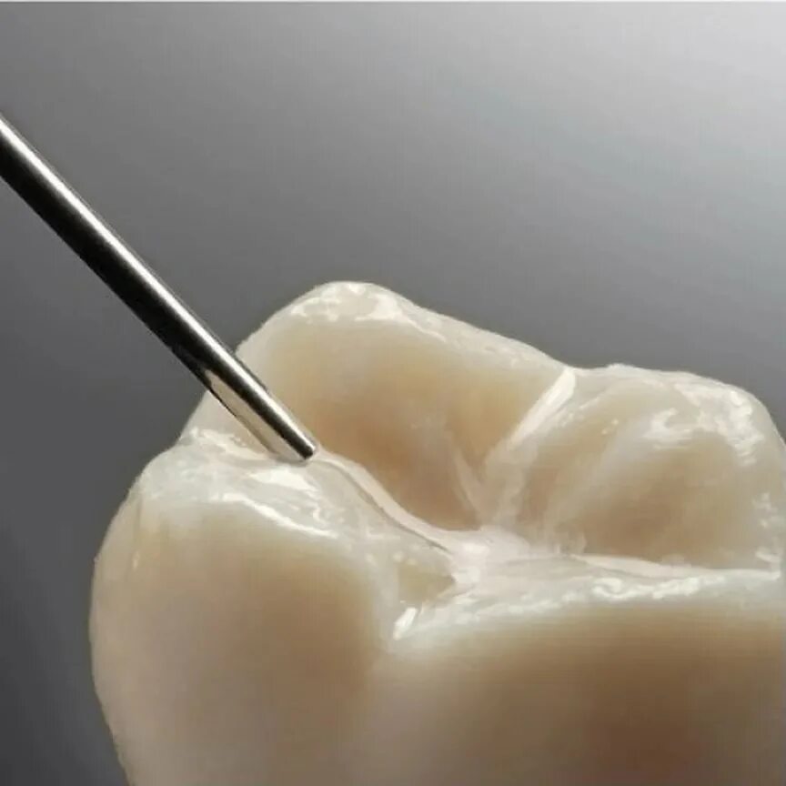 Герметизация фиссур зуба. Этапы инвазивного метода герметизации фиссур. Герметизация фиссур фиссуротомия. Герметизация фиссур стоматология. Герметизация фиссур стоматология.