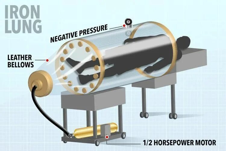Железное легкое аппарат. Стальные легкие аппарат. Как устроен аппарат железное легкое. Железные легкие современный аппарат. Железное легкое что это