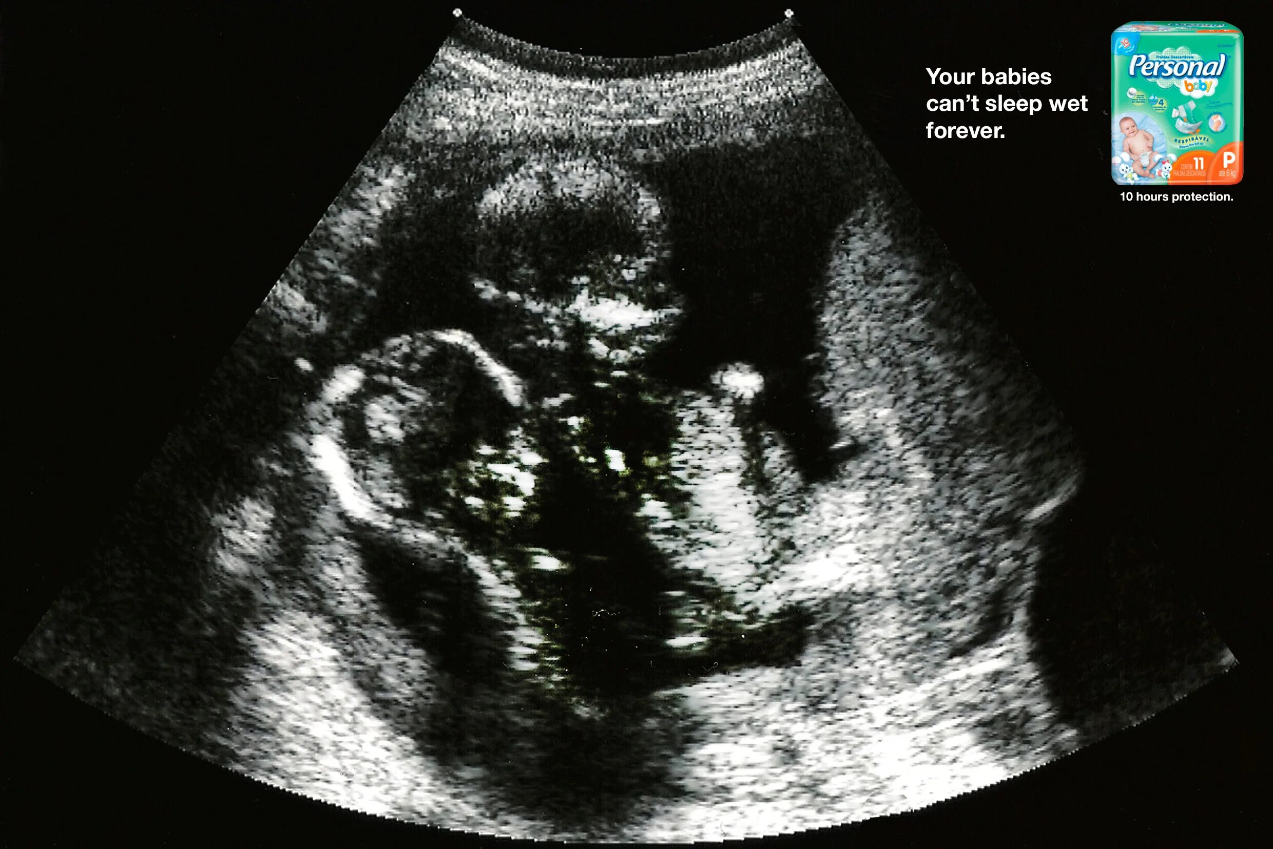 Ребенок на 18 неделе беременности. УЗИ В 16 недель беременности двойняшки. УЗИ двойни на 18 неделе беременности. УЗИ двойни на 16 неделе беременности фото.