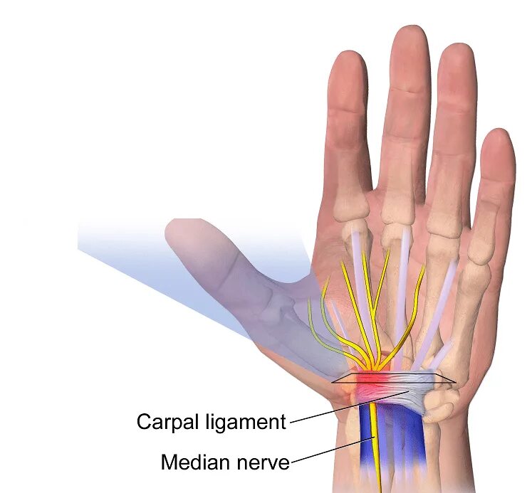 Операция карпального канала кисти. Карпальный туннельный синдром. Карпальный туннельный синдром стопы. Карпальный туннельный синдром рентген. Синдром запястного (карпального) канала.