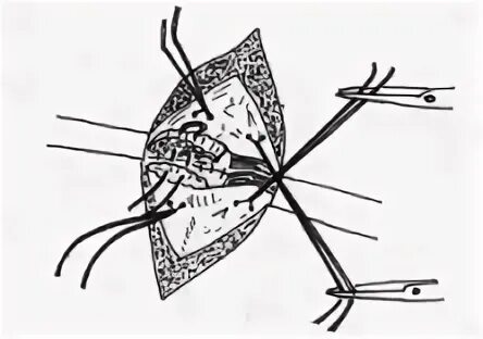 Х образный шов. П образный мышечный шов. Шов хирургический черепашка.