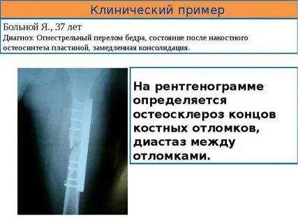 Несросшийся перелом