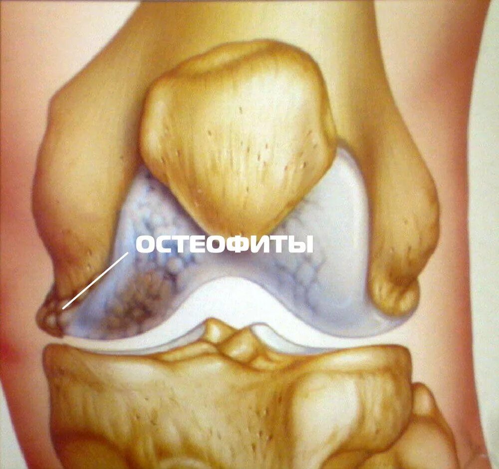 Остеофиты что это такое и как лечить. Остеофиты надколенника рентген. Остеоартроз остеофиты.