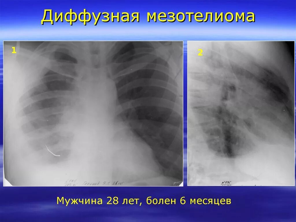 Рак молочной железы метастазы в легких. Злокачественная мезотелиома плевры. Узловая мезотелиома плевры кт. Мезотелиома плевры рентген. Доброкачественная мезотелиома плевры кт.