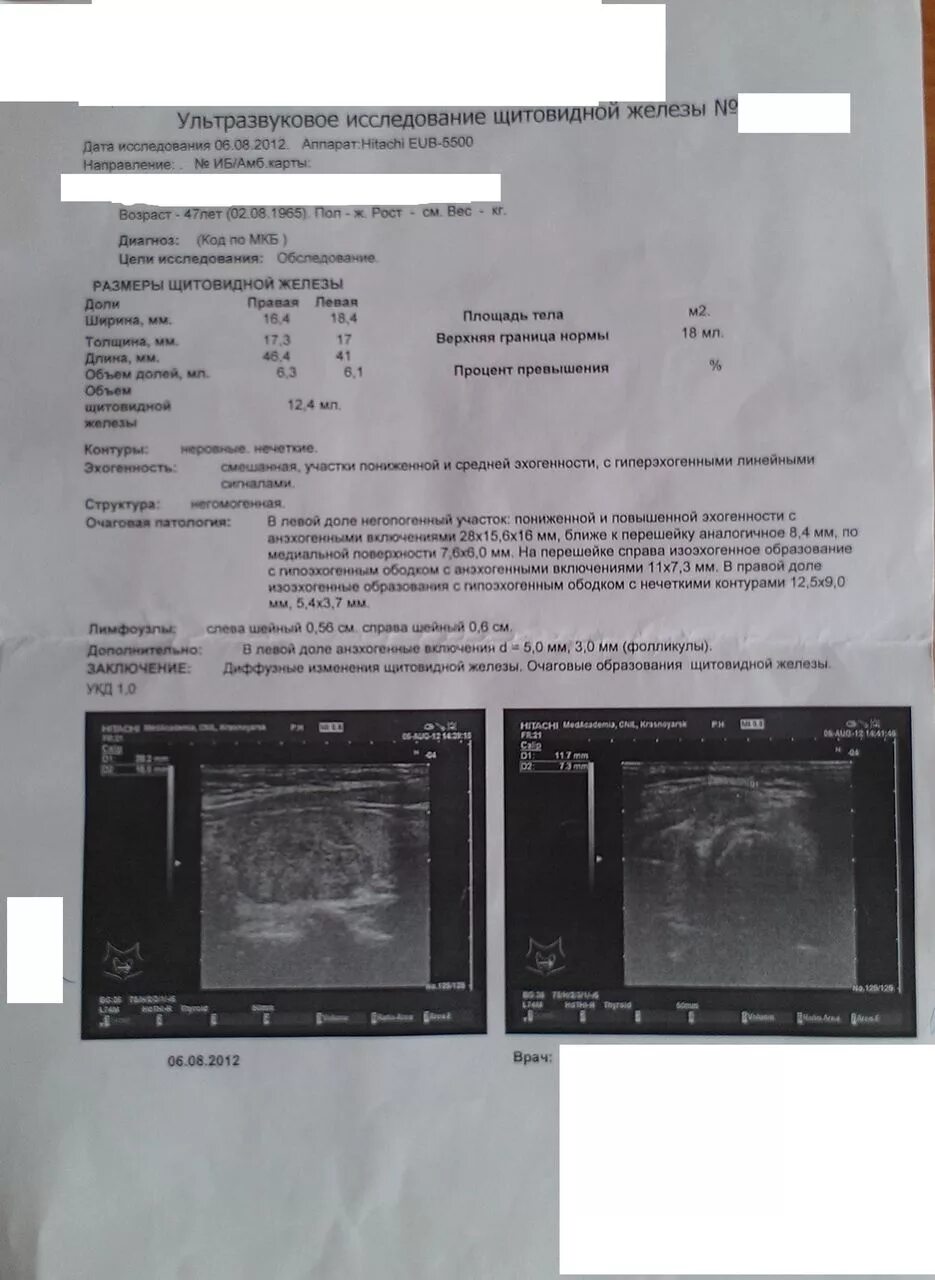 Очаговое образование в правой доле в. Очаговые образования в щитовидной железе на УЗИ. ОСАГО В перешейке щитовидки 7 на 7 мм.