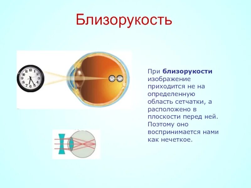 Миопия близорукость глаз. Заболевания органа зрения близорукость и дальнозоркость. Строение глаза при близорукости и дальнозоркости. Миопия и гиперметропия. Перед сетчаткой расположена