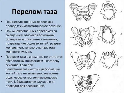 Симфизит 2 степени при беременности