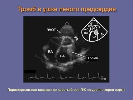 Эхо кс сердца