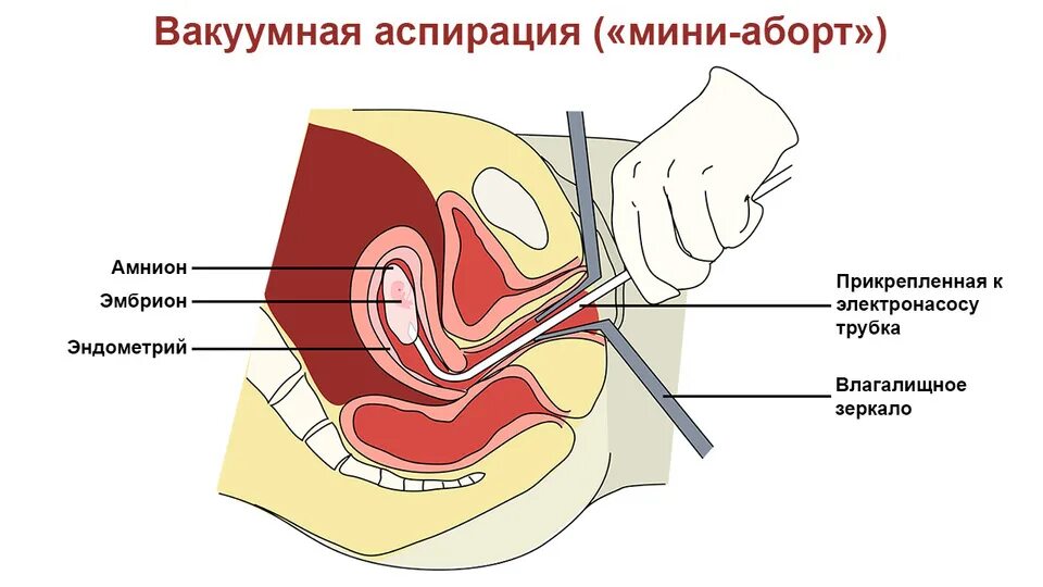 Вакуумная аспирация после замершей беременности. Вакуумная аспирация аборт. Вакуумная аспирация матки. Вакуумный аборт (мини-аборт).