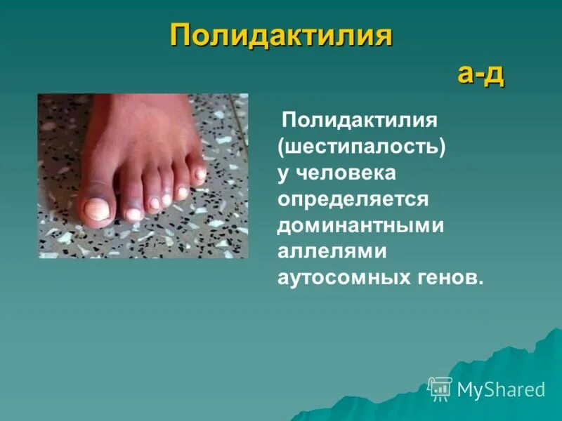 аниридия наследуется как аутосомно доминантный признак. у человека шестипалость определяется доминантным геном. у человека шестипалость детерминирована доминантным. у человека ген полидактилии доминирует над нормальным строением. полидактилия у человека наследуется как.