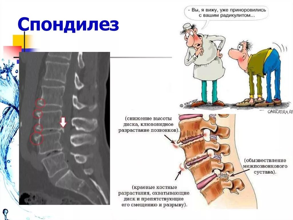 Лечения грудного спондилез