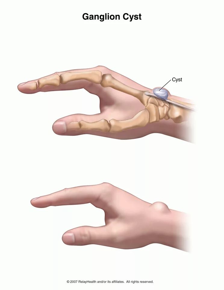 Гигрома сухожильный ганглий. Ганглион лучезапястного сустава.
