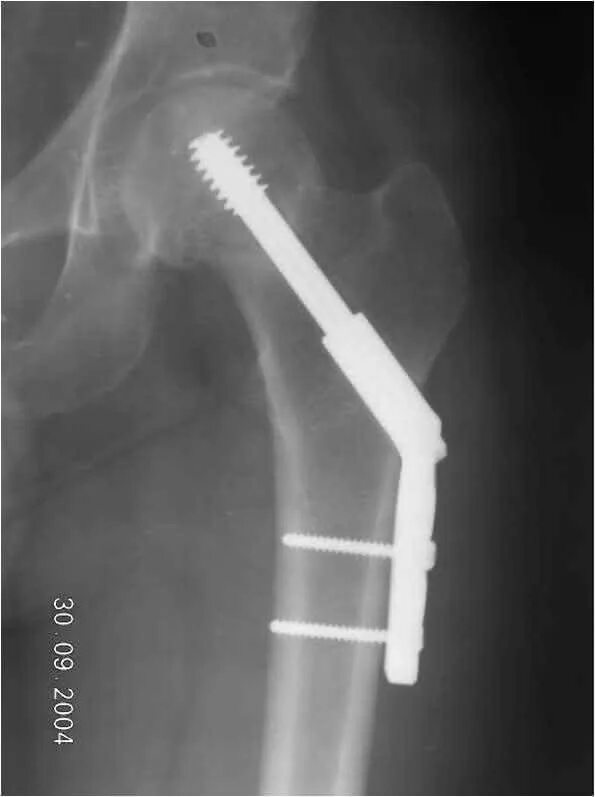 Перелом шейки бедра у пожилых. Шейка бедра перелом в пожилом возрасте. Перелом шейки бедра у пожилых картинка. Перелом бедренной кости в пожилом возрасте операция. Перелом шейки бедра без операции прогнозы