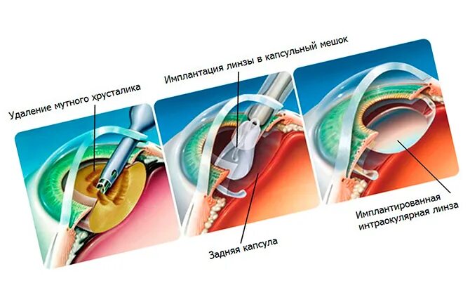 Интраокулярные линзы. Капсульный мешок хрусталика. Расчет интраокулярной линзы. Замена хрусталика что нельзя делать после операции