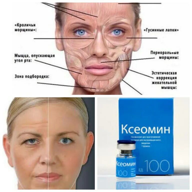 Что нельзя после ботулинотерапии
