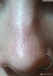 Новое видео удаления комедонов
