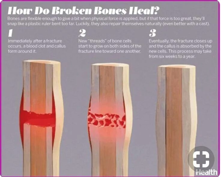 A fracture is a broken bone. Bones heal.