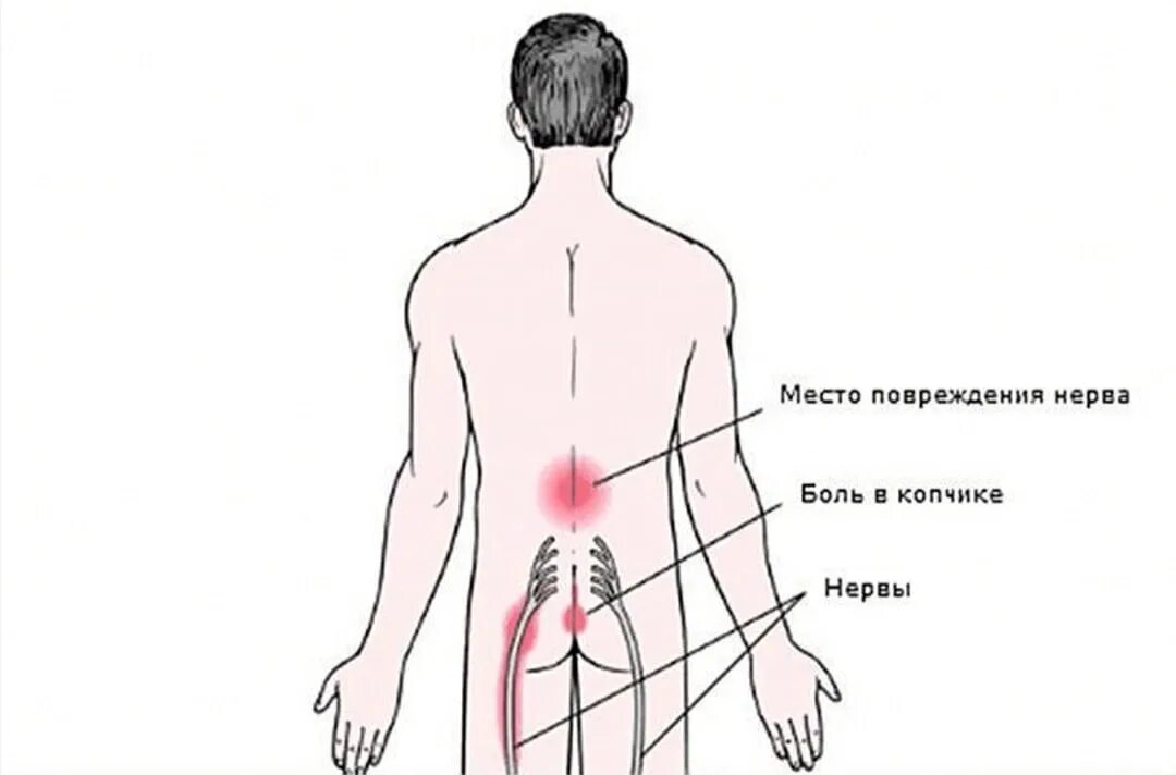 Поясница отдает в левую ягодицу. Боли в спине в области. Пояснично-крестцовый радикулит. Локализация боли в спине. Боль в поясничной области.