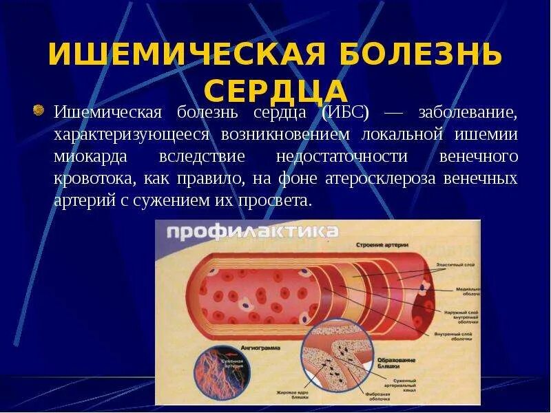 Осложнение ишемической болезни