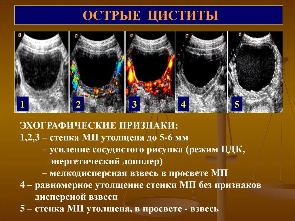 Ультразвуковое исследование (УЗИ) мочевого пузыря. Взвесь в мочевом пузыре на УЗИ что это. Стенки мочевого пузыря на УЗИ. Острый цистит диагностика.