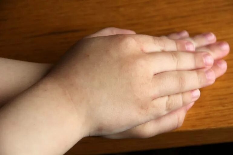 Красные запястья у ребенка. Красные запястья у ребенка. Красные запястья у ребенка. Красные запястья у ребенка. Красные запястья у ребенка.