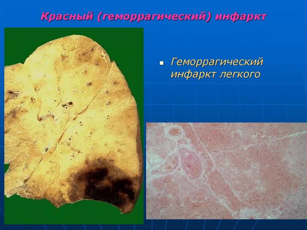 Инфаркт лёгкого микропрепарат. Красный инфаркт легкого микропрепарат. Красный инфаркт легкого микропрепарат. Геморрагический инфаркт легкого микропрепарат. Геморрагический инфаркт легкого препарат.