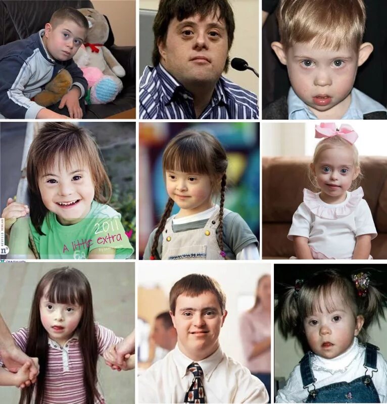 Дети людей с синдромом дауна