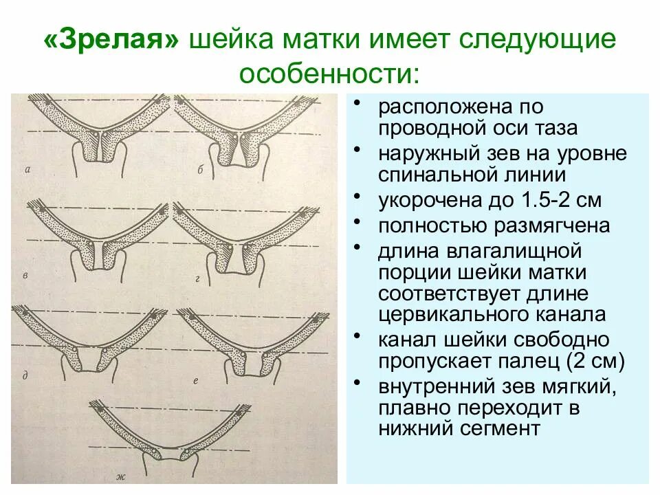 Почему укорачивается матка. Раскрытие шейки матки 1.5 см. Зрелая шейка матки. Шейка матки по проводной оси. Шейка матки по проводной оси таза.