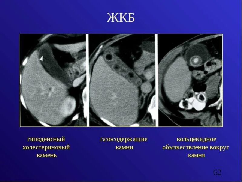 Диагностика жкб. Кт при желчекаменной болезни. Холестериновые конкременты желчного пузыря кт. Желчекаменная болезнь холелитиаз. Желчнокаменная болезнь кт.