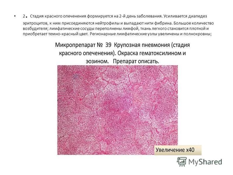 стадия опеченения при пневмонии. крупозная пневмония стадия красного опеченения макропрепарат. этапы развития крупозной пневмонии. красное опеченение. стадия уплотнения при пневмонии.