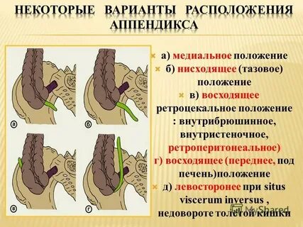 Виды аппендицита