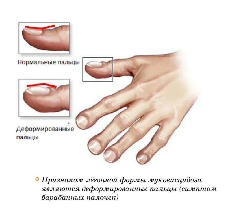 Фаланги пальцев форма