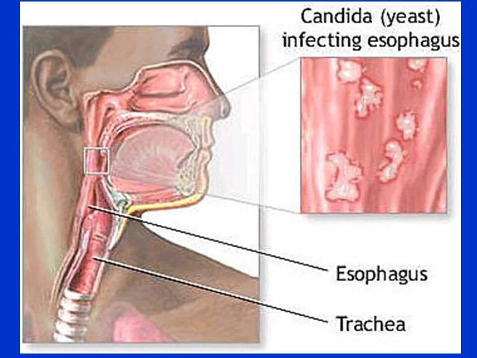 Грибковое поражение горла. Кандидозное поражение пищевода. Грибковое поражение гортани. Глотка трахея пищевод