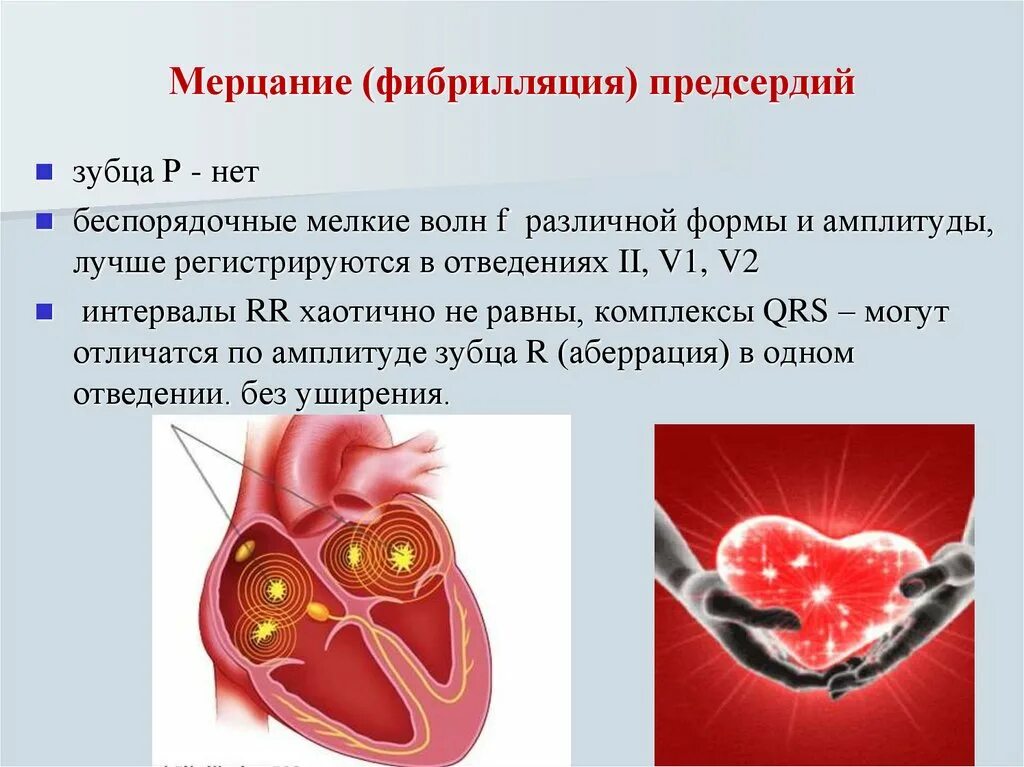 Фибрилляция сердца. Аритмия предсердий. Фибрилляция и мерцание предсердий. Меоцание итрепетение предсердий. Предсердие болезни