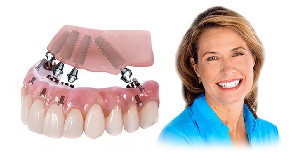 Снимать ли зубные протезы на ночь. All on 4 имплантация Нобель. Импланты Nobel all-on 04 зубов.