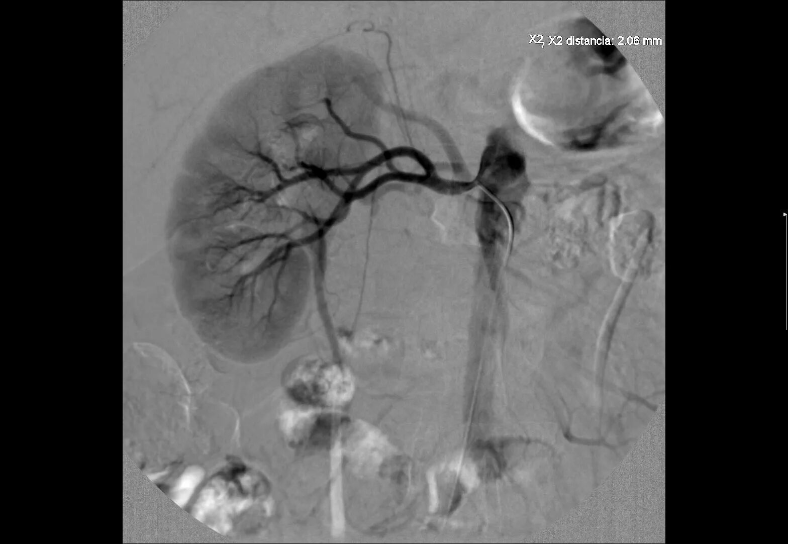 Радиоизотопная ангиография. Ангиография снимки. Радиоизотопная ангиография. Тромбоз артерий нижних конечностей кт. Мр-ангиография сосудов головного мозга.