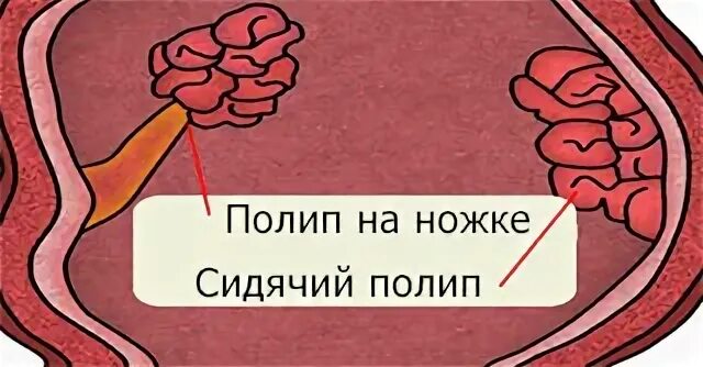 Как лечить полипы в желудке