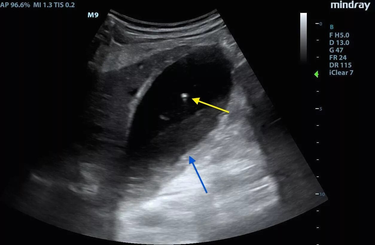 Сморщенный желчный пузырь. УЗИ желчного пузыря холецистит. Водянка желчного пузыря на УЗИ. УЗИ картина водянки желчного пузыря. Эффект реверберации на УЗИ.