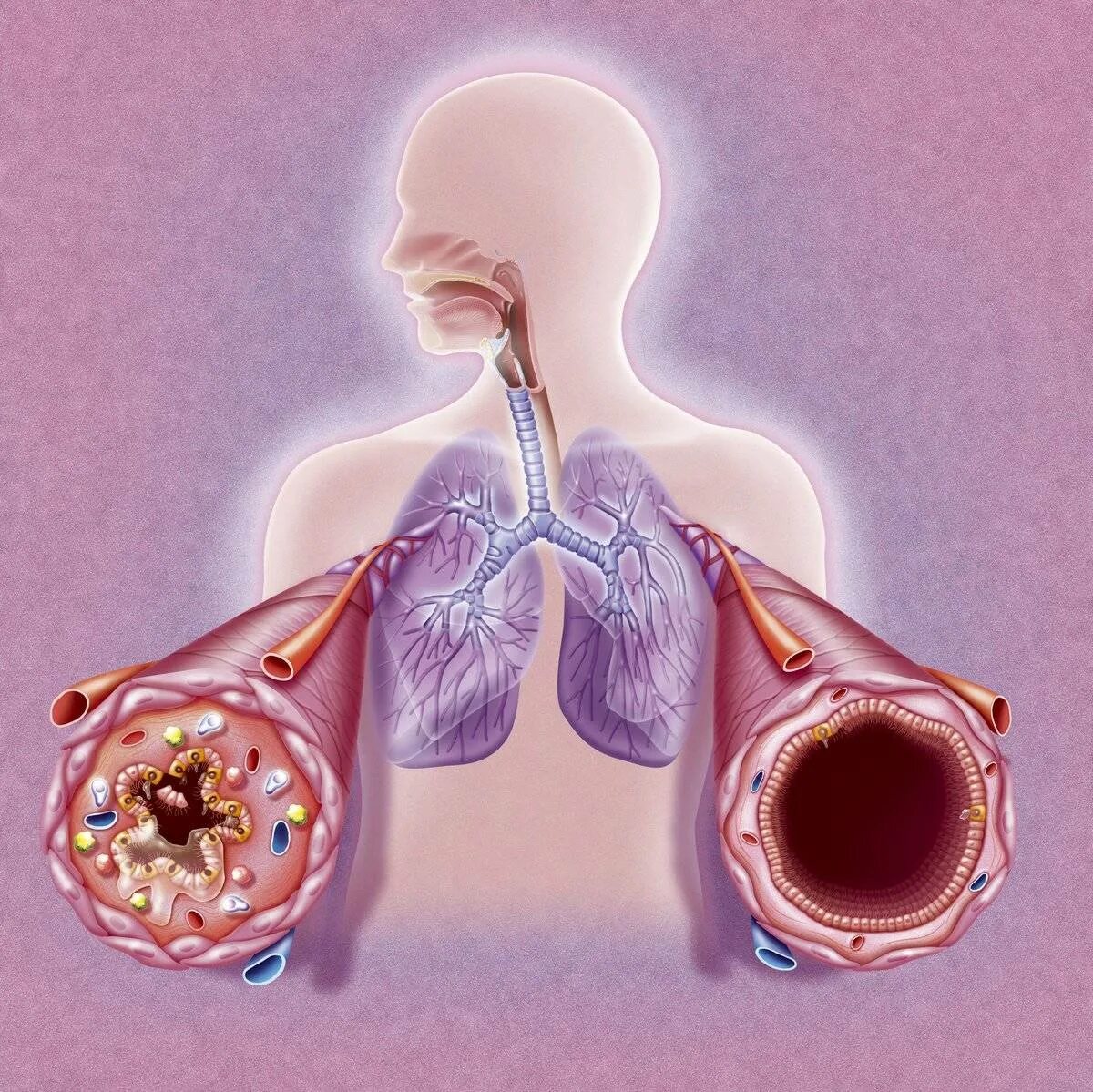 Хроническими болезнями легких астмой. Обструкция дыхательных путей бронхиальная астма. Бронхиальная астма легкие.