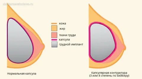 Можно ли кормить имплантами
