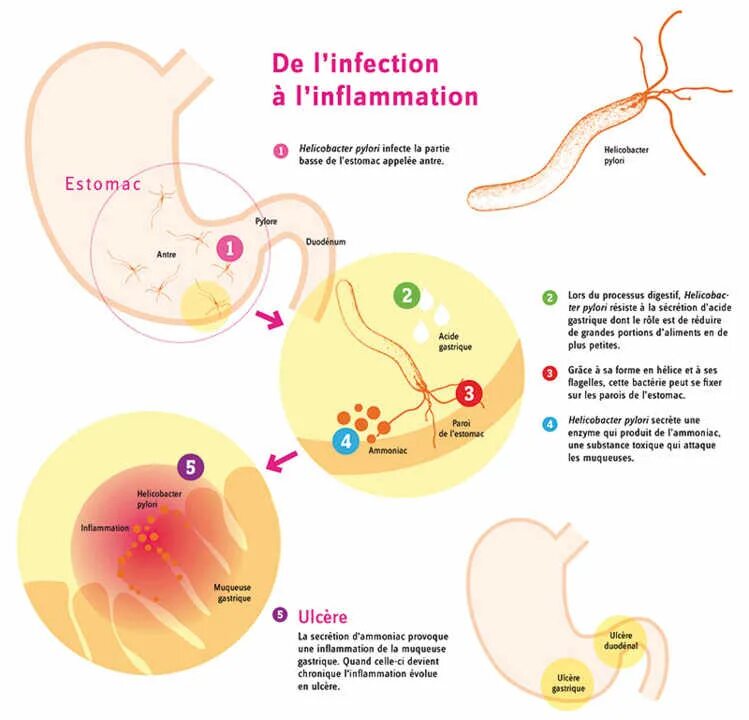 Хеликобактер язык. Helicobacter pylori вырабатывает фермент. Пути передачи хеликобактер пилори. Носители хеликобактер пилори. Хеликобактер пилори язык.