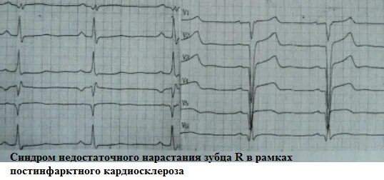Нарастание зубца r. Изменения на ЭКГ постинфарктный кардиосклероз. Элевация St в v1-v3. ЭКГ при постинфарктном кардиосклерозе. Изменения на ЭКГ при постинфарктном кардиосклерозе.