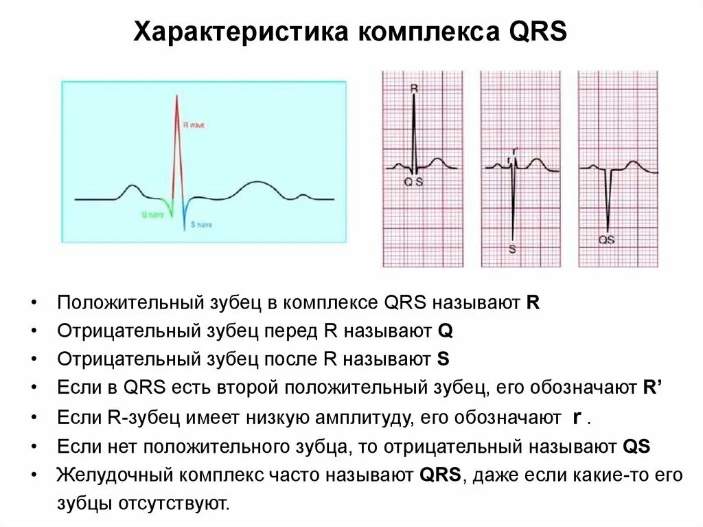 Qrs на экг что это. Отрицательный комплекс QRS на ЭКГ. Отрицательный зубец р после QRS комплекса. Отрицательный QRS во 2 отведении. Отрицательный комплекс QRS во 2 отведении.