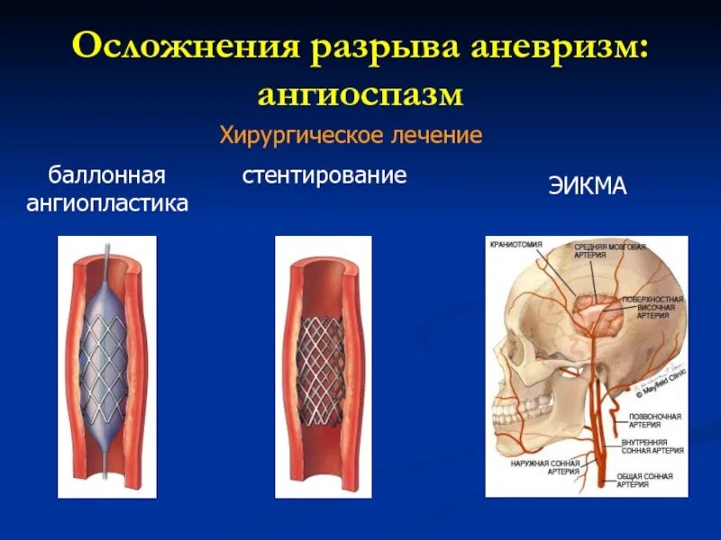 Стентирование аневризмы. Осложнения ангиопластики. Осложнения разрыва аневризмы. Баллонная ангиопластика.