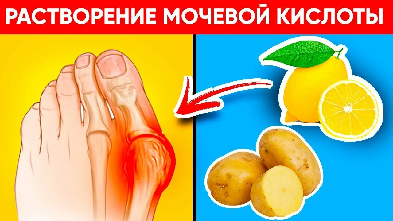 Таблетки от мочевой кислоты в суставах. Уменьшение мочевой кислоты. 10 Продуктов растворят Кристаллы мочевой кислоты. Подагра мочевая кислота. Выведение мочевой кислоты.