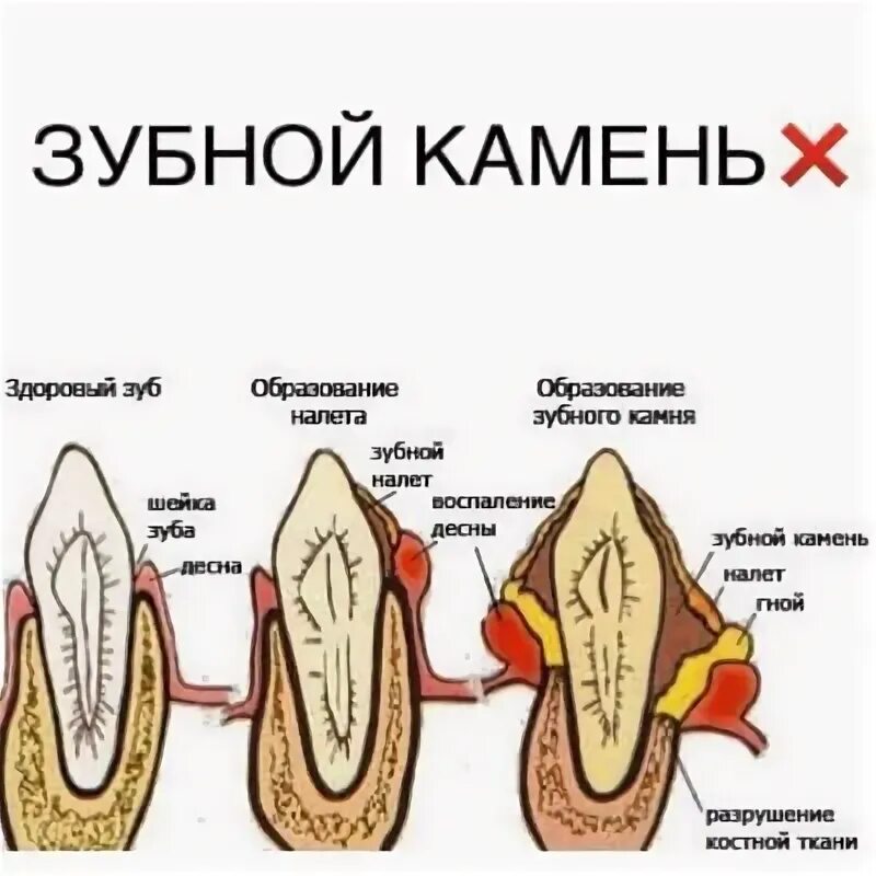 How I Whiten My Teeth At Home In 3 Days & Remove Dental Plaque Without G... in 2