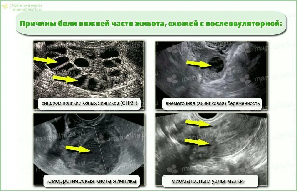 Почему боль в яичниках. Рези в яичниках причины. Боль в яичнике при овуляции. Болит киста в яичник при овуляции. Боль в левом яичнике при овуляции.