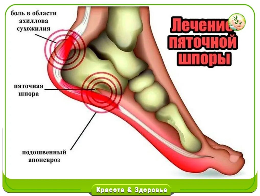 Вылечить пяточную шпору народными. Вылечить пяточную шпору народными